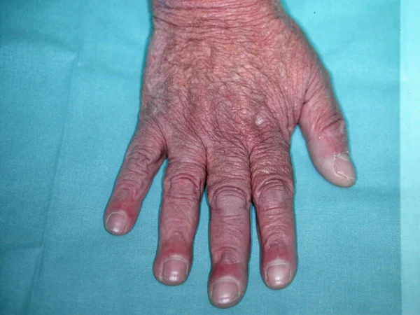 Síndrome Bazex Acroqueratose Paraneoplásica Uma Erupção Psoriasiforme Mais Frequente Homens — Fotografia de Stock