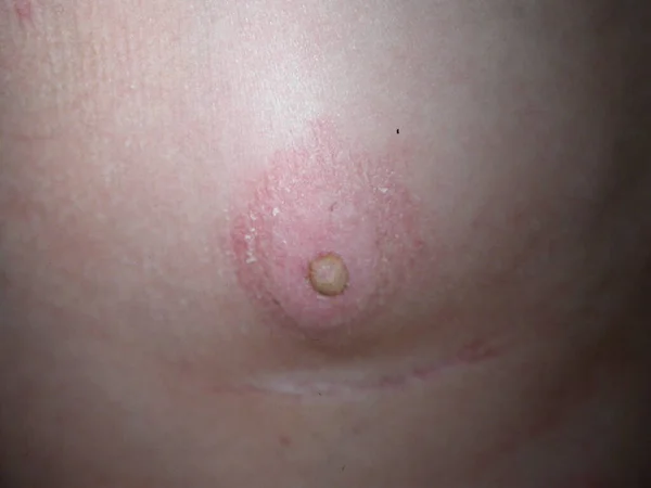 Syndrome Bazex Acrokératose Paranéoplasique Est Une Éruption Psoriasiforme Qui Manifeste — Photo