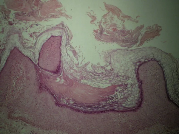 Bazex Szindróma Vagy Paraneoplasticus Acrokeratosis Egy Pikkelysömör Kitörés Amely Gyakrabban — Stock Fotó