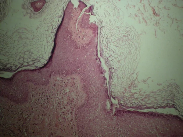 鲍兹氏综合征 Bazex Syndrome 又称医源性医源性皮肤角化症 Paraneoplastic Acrokeratosis 是一种银屑病 在成年白种人男性中较为常见 其特征是以尖锐湿疣为主的分布 — 图库照片