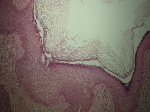 鲍兹氏综合征 Bazex Syndrome 又称医源性医源性皮肤角化症 Paraneoplastic Acrokeratosis 是一种银屑病 在成年白种人男性中较为常见 其特征是以尖锐湿疣为主的分布 — 图库照片