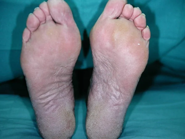 Bazex Syndrome Paraneopoporstic Acrokeratosis 코카서스 남성에게 나타나며 디스트로피가 Acral 분포가 스톡 이미지