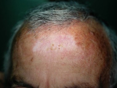 Kriyoprob adı verilen çok soğuk bir sıvı ya da anormal dokuyu dondurmak ve yok etmek için kullanılan bir yöntemdir. Kriyoprob sıvı nitrojen, sıvı nitrojen oksit veya sıkıştırılmış argon gazı gibi maddelerle soğutulur..