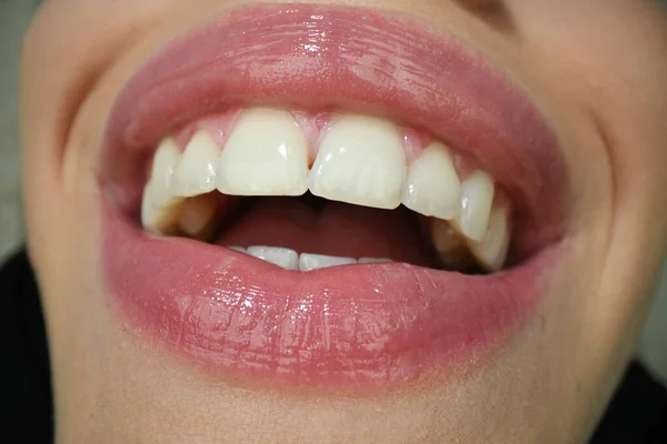 Sonriente boca. Cuidado dental, dientes sanos y sonrisa, dientes blancos en la boca. Primer plano de sonrisa con dientes blancos y sanos. —  Fotos de Stock