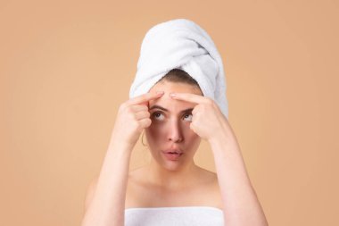 Yüzüne sivilce çıkaran güzel bir kız. Sivilce lekeleri genç bir kadında deri lekesi. Benekli sivilce, çiller ve melasma pigmentasyonu yüz bakımı, sorunlu cilt konsepti..