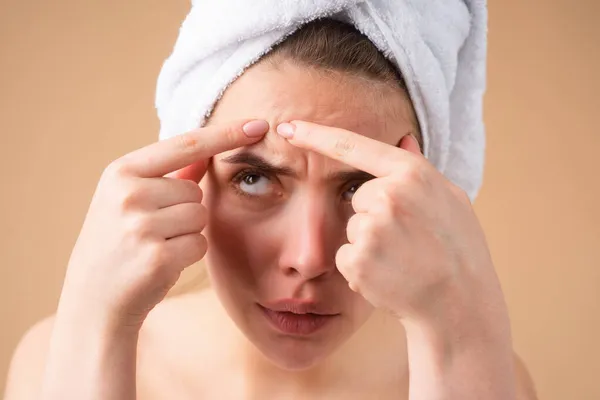 Una mujer de cerca apretando espinillas en su cara. Manchas de acné mancha piel en la mujer joven. Mancha cicatriz acné, pecas y melasma pigmentación piel tratamiento facial, concepto de piel problema. — Foto de Stock