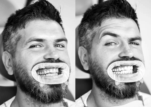 白色牙齿-之前和之后的概念。人的牙齿在美白前后的特写细节。牙齿美白的结果。漂白后的完美微笑. — 图库照片