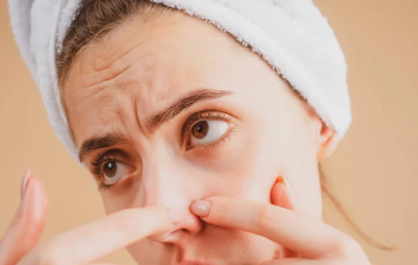 女性はにきびを絞る顔を閉じます。若い女性ににきびシミ肌。スポット瘢痕にきび、そばかす、およびメラーマ色素沈着皮膚の顔の治療、問題の肌の概念. — ストック写真
