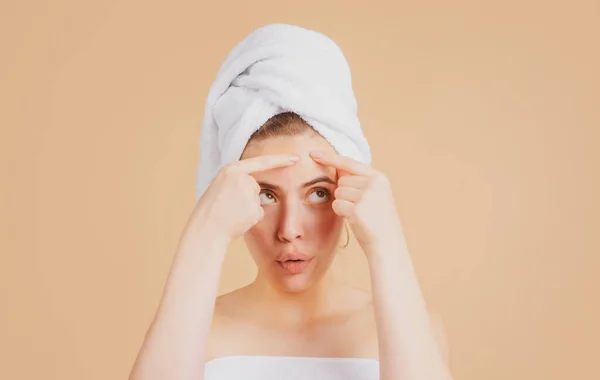 Hermosa chica apretando granos en su cara. Manchas de acné mancha piel en la mujer joven. Mancha cicatriz acné, pecas y melasma pigmentación piel tratamiento facial, concepto de piel problema. — Foto de Stock