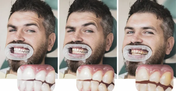 Hombre aislado en dientes blancos: antes y después del concepto. Concepto de estomatología: primer plano del dentista femenino con dientes de paciente masculinos. Dientes blancos o amarillos . — Foto de Stock