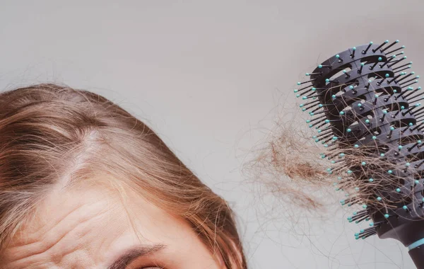 Concepto de pérdida de cabello. Pérdida de cabello de cerca. enredado Problema de cabello. —  Fotos de Stock