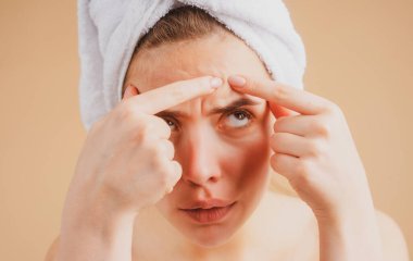 Yüzünde sivilceler olan bir kadın. Sivilce lekeleri genç bir kadında deri lekesi. Benekli sivilce, çiller ve melasma pigmentasyonu yüz bakımı, sorunlu cilt konsepti.