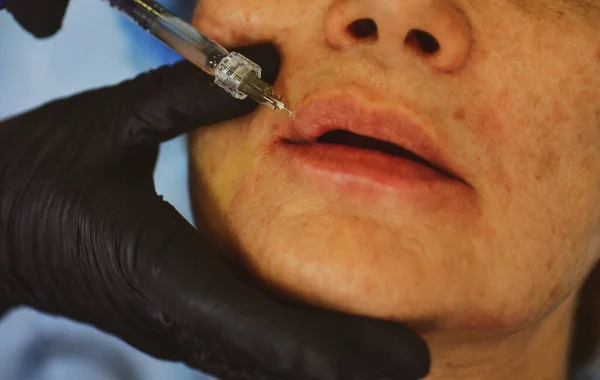Primeros Labios Mujer Aumento Del Procedimiento Jeringa Boca Femenina Inyección —  Fotos de Stock