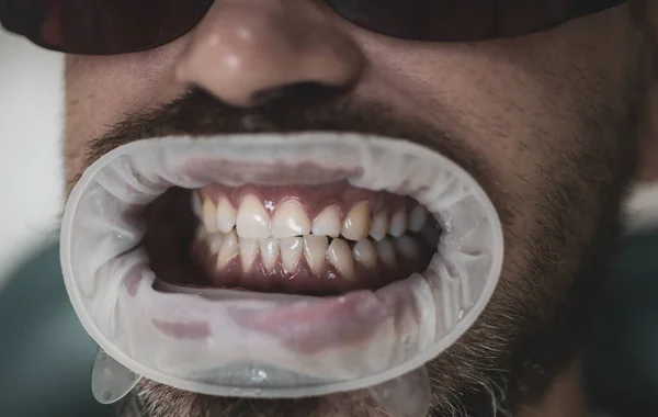 Blanchiment Des Dents Clinique Dentaire Administrez Des Anesthésiques Pour Éviter — Photo
