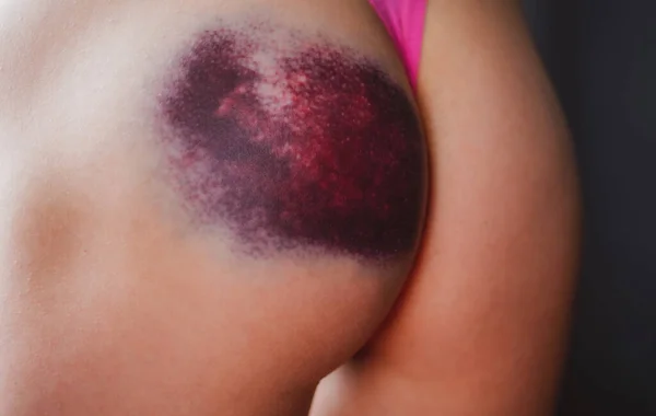 Hematoma Female Butt Leg Woman Buttocks Bruise Domestic Violence Concept — Fotografia de Stock