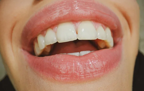 Gülümseyen Ağız Diş Bakımı Sağlıklı Dişler Gülümseme Ağzında Beyaz Dişler — Stok fotoğraf