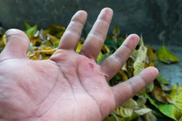 Close Palm Asian Male Adult Blister Heavy Work Uttarakhand India — 图库照片