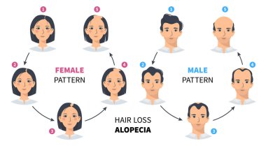 Saç dökülmesi aşamaları, androgenetik alopecia erkek ve kadın deseni. Kellik vektör çemberinin basamakları bir erkek ve bir kadınla düz bir tarzda bilgi verir. Kafa derisindeki saç çizgisini değiştirmek.