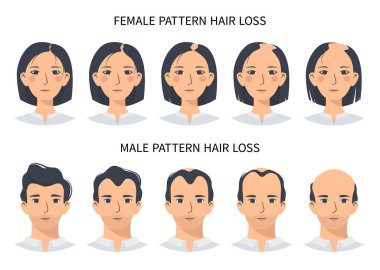 Saç dökülmesi aşamaları, androgenetik alopecia erkek ve kadın deseni. Kellik vektör bilgisinin basamakları düz bir şekilde bir erkek ve bir kadınla. Kafa derisindeki saç çizgisini değiştirmek.