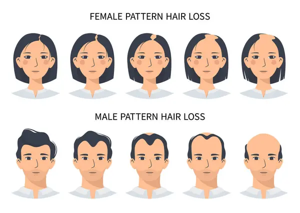 头发脱落阶段 雄性激素变异的男性和女性模式 一个男人和一个女人的光秃秃的步骤 改变头皮上的发际 — 图库矢量图片