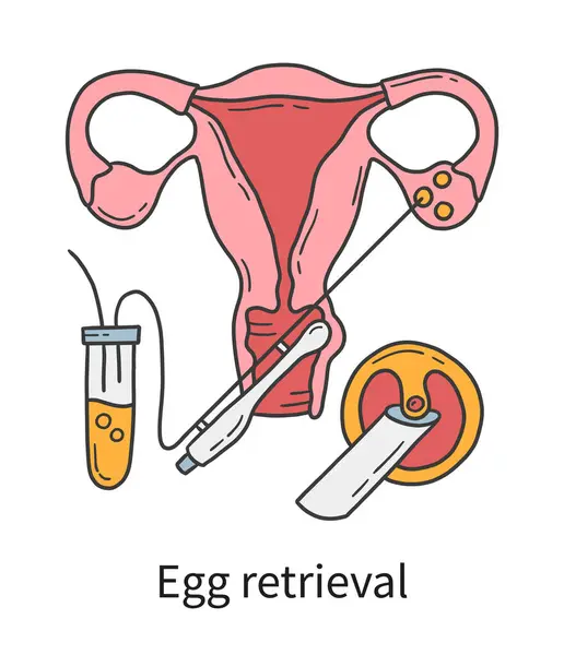 Egg Retrieval Transvaginal Oocyte Extraction Ovaries Vitro Fertilization Ivf Vector — стоковый вектор