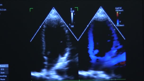 Cardiac Ultrasound Stock Footage