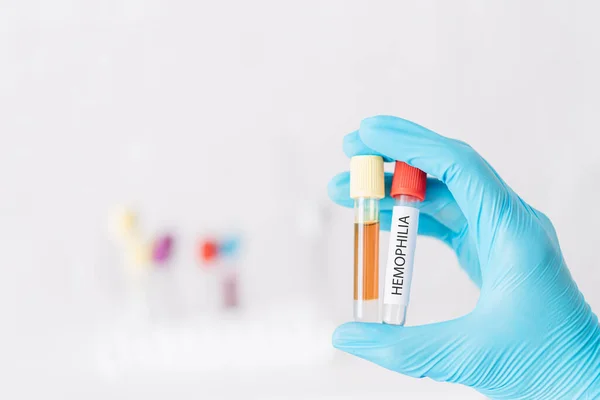 Hand holding two test tubes with plasma and hemophilia — Fotografia de Stock