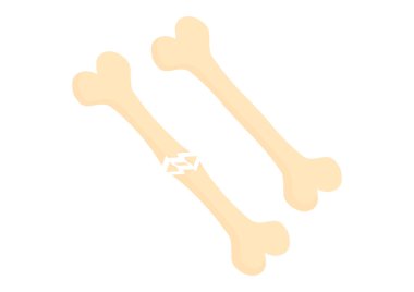 Kırık kemikler ve normal kemiklerin bembeyaz arka planda tıbbi bir temada resmedilmesi