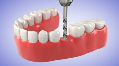 diş implantı yükleme işlemidir. HD