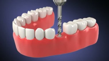 diş implantı yükleme işlemidir. HD