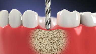 diş implantı yükleme işlemidir. HD