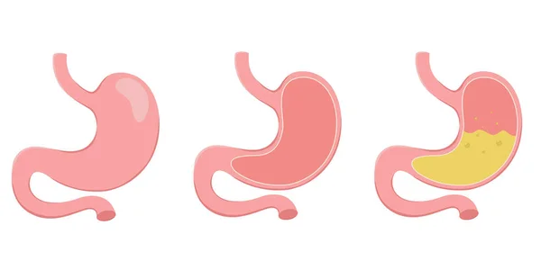 Sağlıklı ve sağlıksız, boş ve dolu bir insan midesi. Sindirim sistemi anatomisi. Vektör illüstrasyonu beyaz arkaplanda izole edildi.