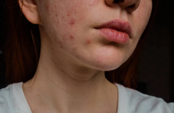 Problema de piel en una chica joven. Primer plano de las espinillas en la cara. — Foto de Stock