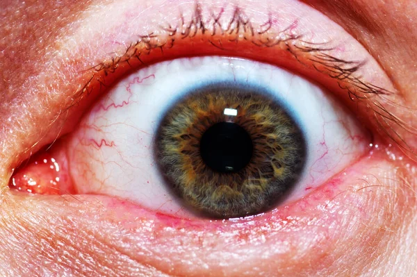 Podrażnione czerwone przekrwione oko Zaczerwienienie na męskim oku, — Zdjęcie stockowe