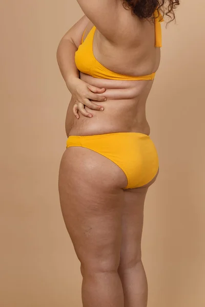 Imagen recortada de una mujer gorda con sobrepeso y caderas obesas, exceso de grasa en traje de baño amarillo. Liposucción — Foto de Stock