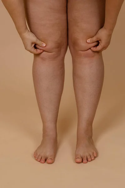 Obcięte zdjęcie kobiety gołymi nogami, szczypiącej tłuszcz na kolanach. Przycinam fałdy tłuszczu. Opieka ciała. Tłuszcz pompuje. Skóra żylaków — Zdjęcie stockowe