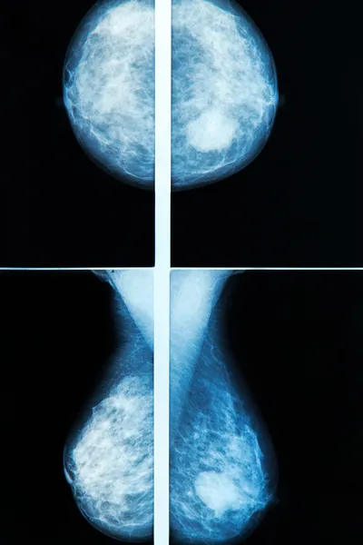 Mammografi