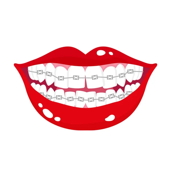 Wektorowe Kreskówki Uśmiechnięte Usta Etapami Krzywego Osiowania Zębów Pomocą Ortodontycznych — Wektor stockowy