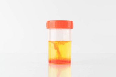 Laboratuvarda kan örneği şişesi (hematuria) bulundu. Hematüriye idrar yolu enfeksiyonu, böbrek enfeksiyonu, mesane taşı, prostatit veya kanser neden olmuş..