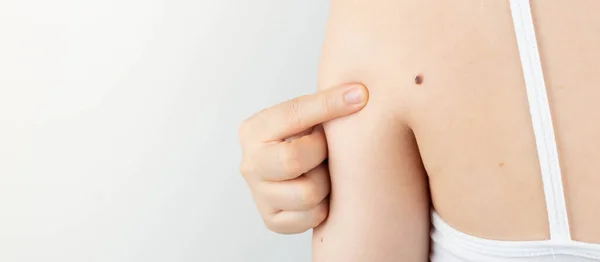 Young Woman Pointing Dark Brown Moles Her Back Self Exams — Stock Photo, Image