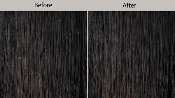 Przed Leczeniu Łupież Łojotokowe Zapalenie Skóry Zbliżenie Długie Czarne Włosy — Zdjęcie stockowe