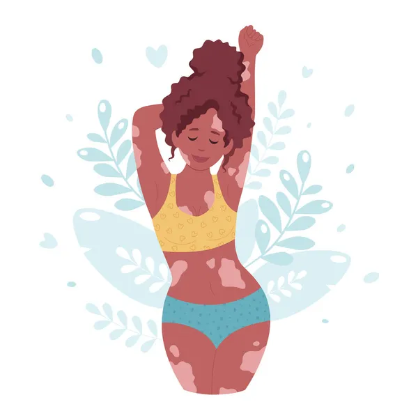 白癜风的黑人女人世界白垩风日 自我照顾 自我爱 身体积极 — 图库矢量图片