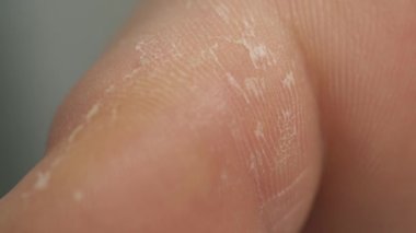 Bir çocuk evdeki mantar enfeksiyonundan etkilenmiş ayağına bakar.