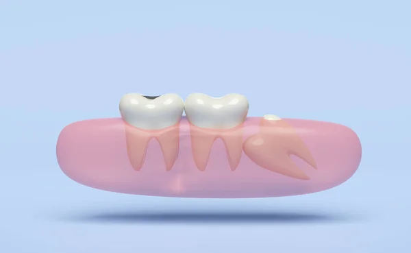 Модель Проблем Зубів Мудрості Значок Яснами Ізольовані Синьому Фоні Стоматологічний — стокове фото