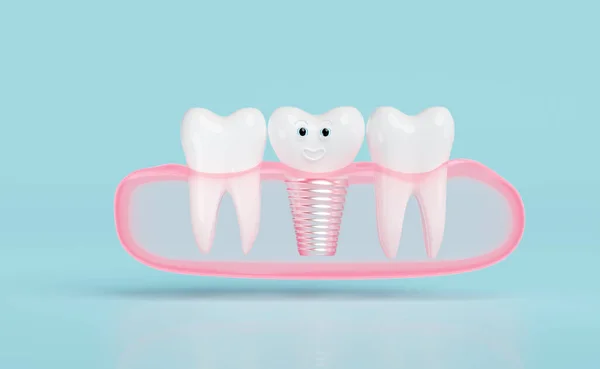 Gum Dental Implant Isolated Blue Background Render Illustration — Stock Photo, Image