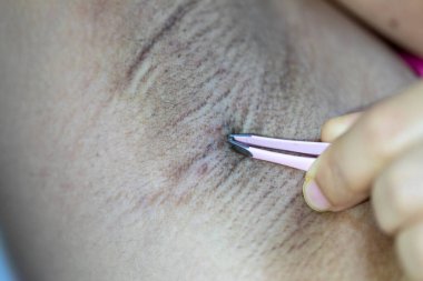 Laboratuvarda mikroskop altında insan derisi ve saç kökleri..