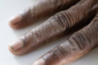 Pattern of Atopic eczema and fungal diseases on the human body.