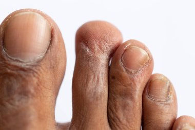 Pattern of Atopic eczema and fungal diseases on the human body.