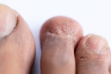 İnsan vücudunda egzama ve mantar hastalıklarının seyri.