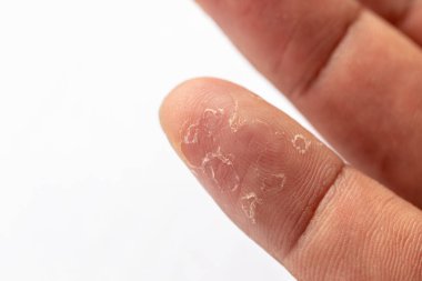 İnsan vücudunda egzama ve mantar hastalıklarının seyri.